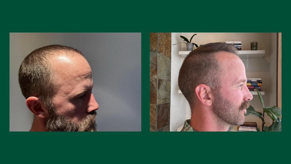 Exosome Hair Restoration Results